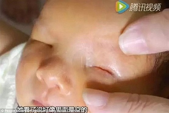 تولد نوزاد بدون چشم مادرش را شوکه کرد (عکس)