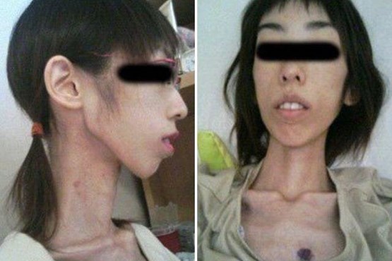 شکنجه دختر ژاپنی با کاهش وزن! (عكس)