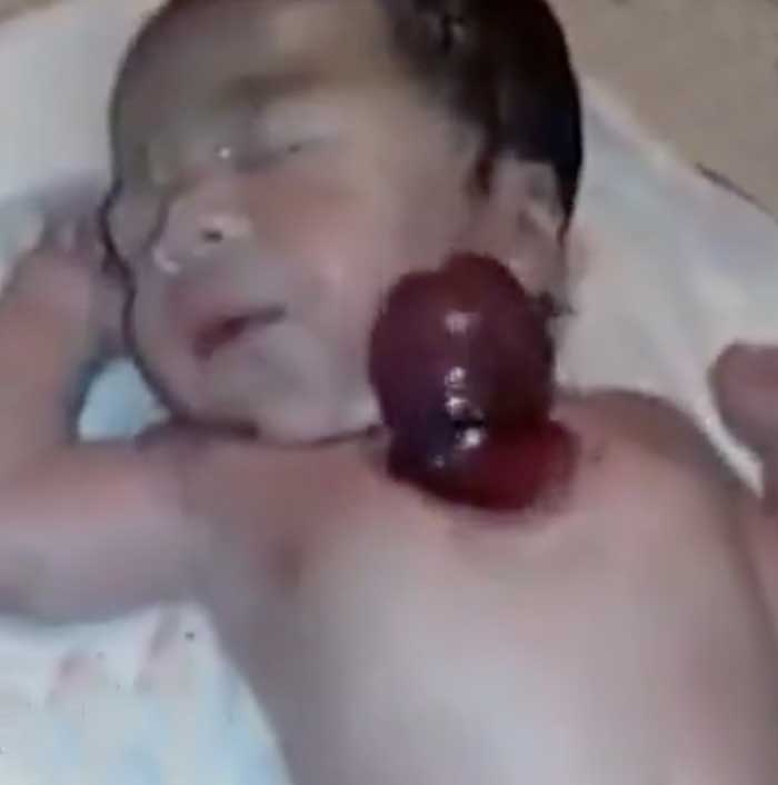 نوزادی که قلبش خارج از بدنش می‌تپد (+عکس)