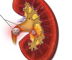 انواع سنگ کلیه