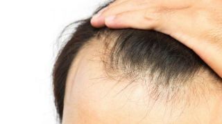 بایدها و نبایدهای مقابله با ریزش مو