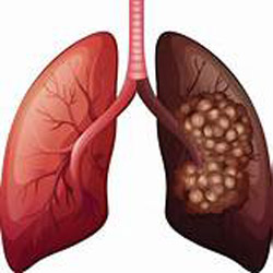 علائم اولیه سرطان ریه