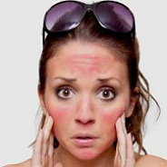 آیا روغن نارگیل برای درمان آفتاب سوختگی پوست مناسب است؟