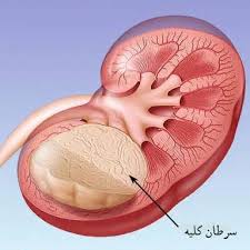 شایع ترین علائم سرطان کلیه