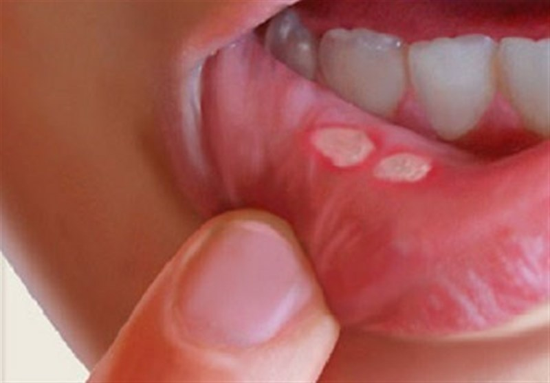 درمان آفت دهان+علل و راه‌های درمان