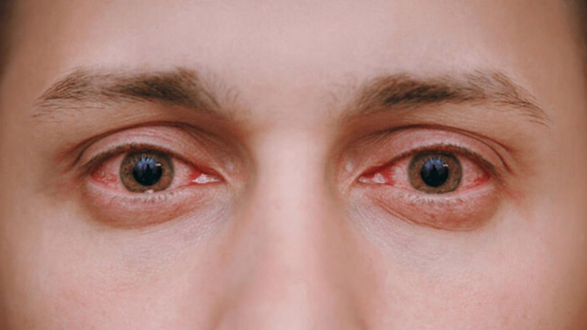 برای قرمزی چشم‌ها چه زمانی به پزشک مراجعه کنیم؟