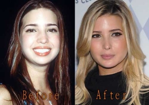 ایوانکا ترامپ قبل و بعد از عمل زیبایی (+عکس)