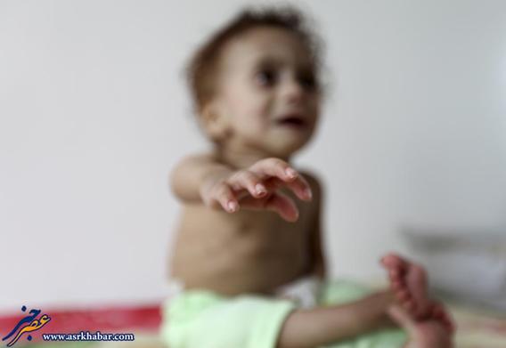 تصاویر دلخراش از گرسنگی کودکان یمن