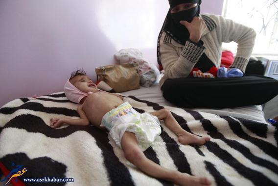 تصاویر دلخراش از گرسنگی کودکان یمن